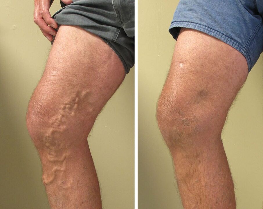 Experience of using ZXCVBNMQWert gel