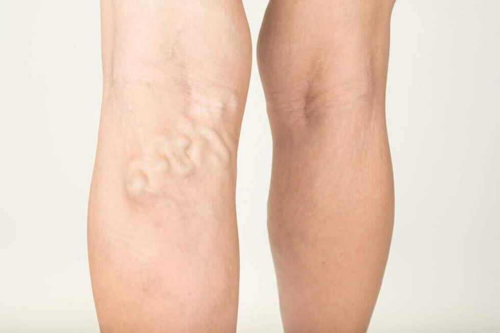 The manifestation of the vein with varicose