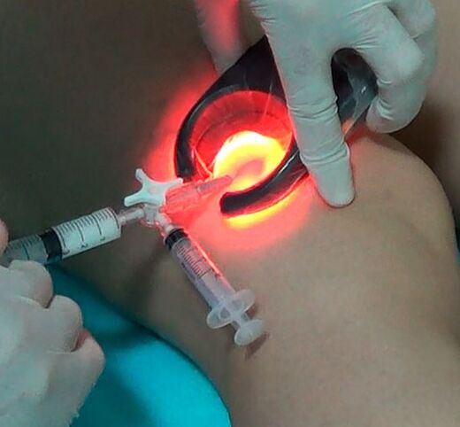 Treatment of Varicose veins
