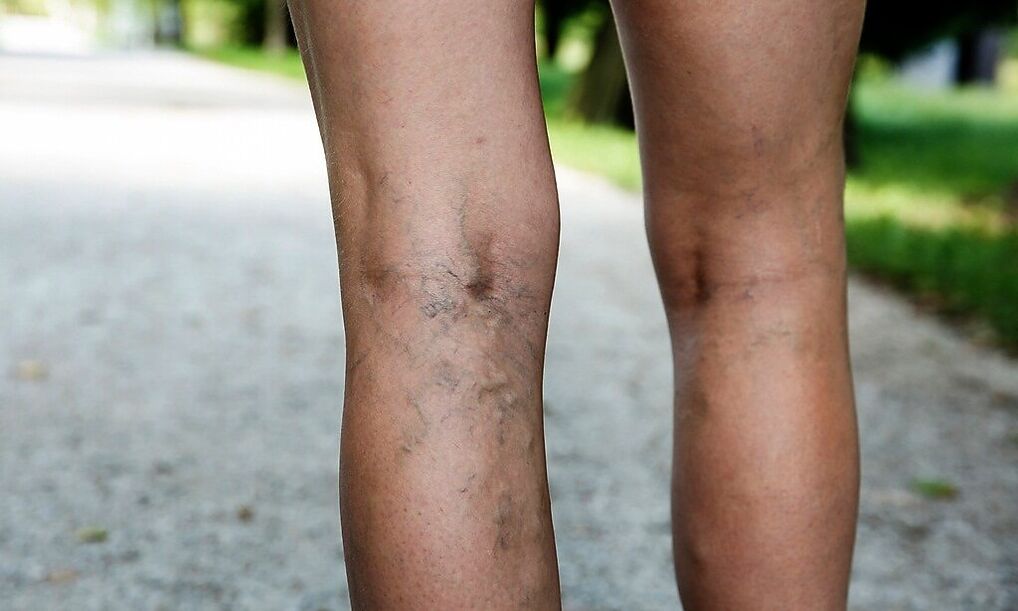 Extended veins in the legs