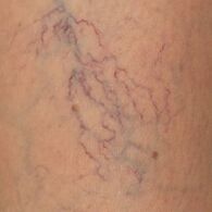The manifestations of varicose veins