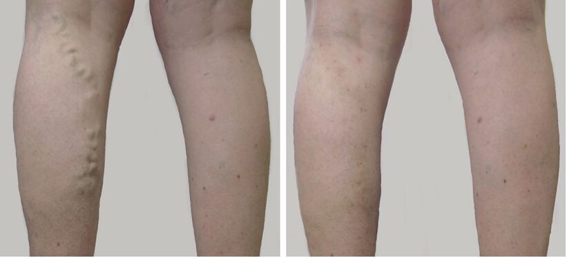 Before and after treatment