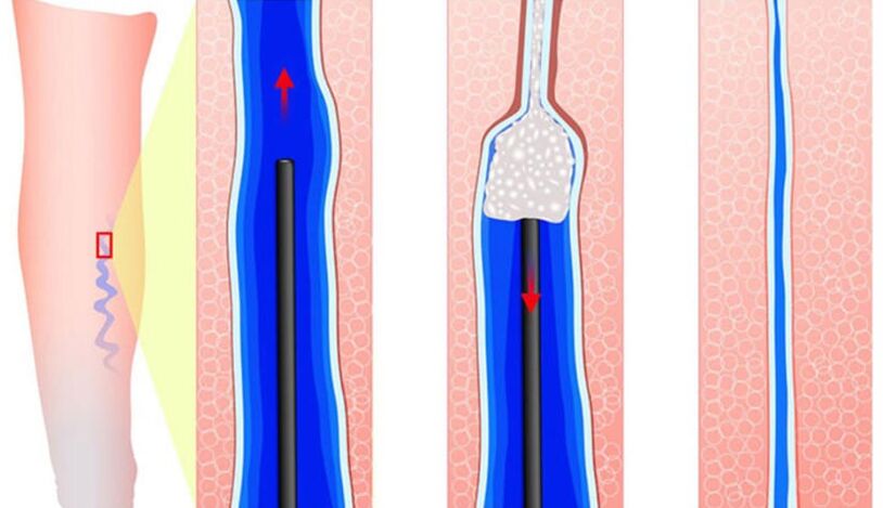 Sclerosant presentation in sclerotherapy