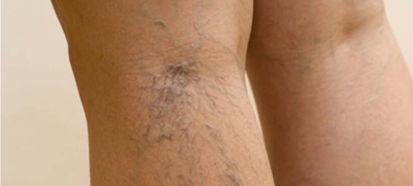 Varicose veins in the legs