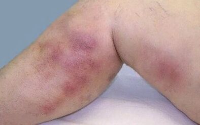 How the varicose veins manifested