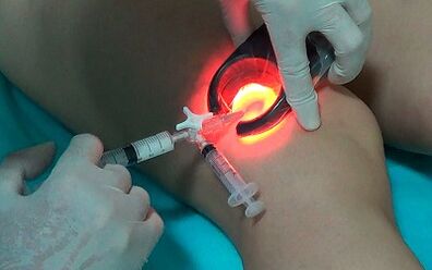 Sclerotherapy as a way to treat varicose veins in the legs
