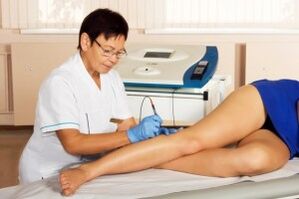 What is varicose veins
