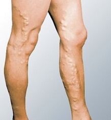 The manifestations of varicose veins