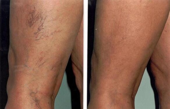 Photo before and after treatment of varicose veins